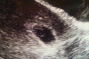 妊娠5週エコー写真