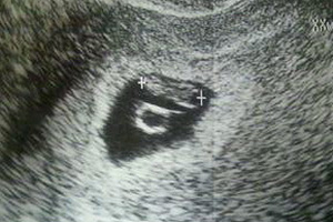 妊娠7週エコー写真